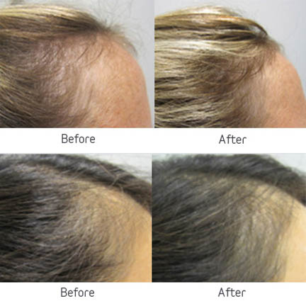 Viviscal Professional Hair Growth Supplements at El Centro Dermatology