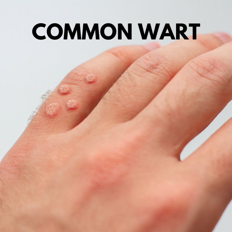 common wart