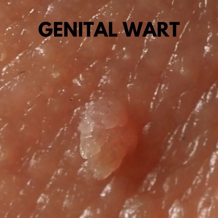 genital wart