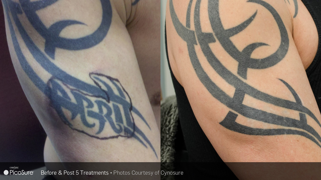 Laser Tattoo Removal Imperial Valley and Yuma - El Centro Dermatology